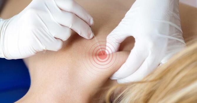 Trigger Point Injections